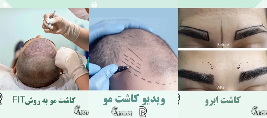 دکتر عبدی از بهترین دکتر کاشت ابرو در قزوین است