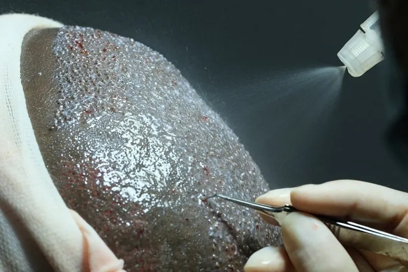 یکی از مراحل مهم و اثرگدار در مراحل رشد مو بعد از کاشت، مراقبت از آن است