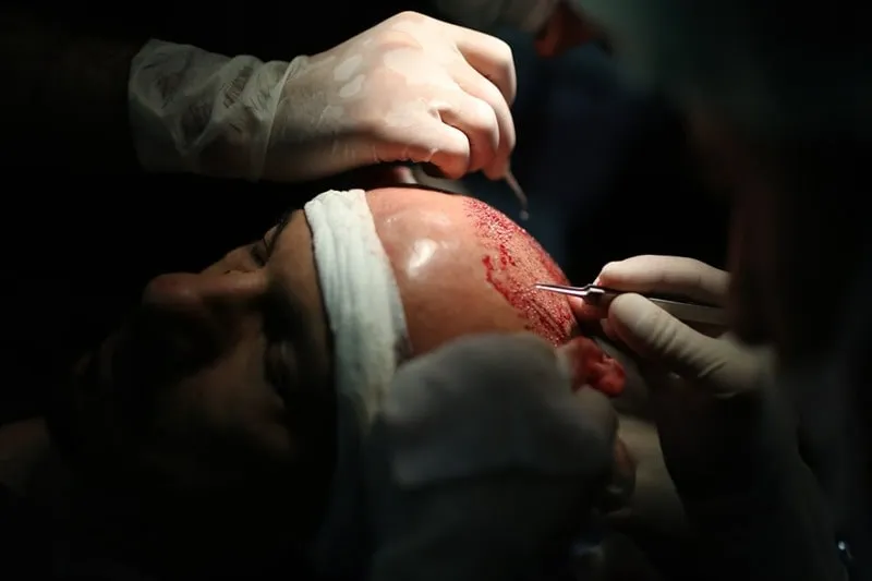 بهترین زمان کاشت مو شرایط هر فرد تعیین و مشخص میکند.