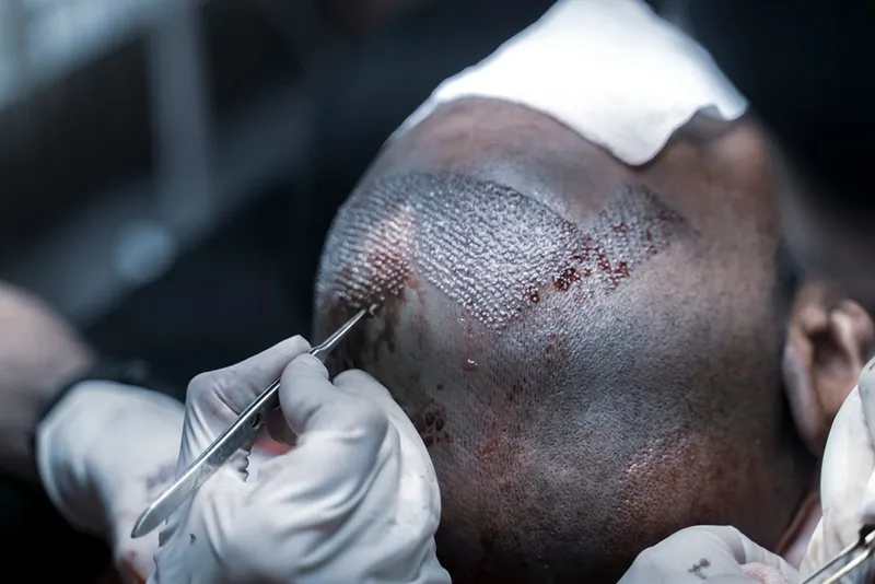 ریزش مو بعد از کاشت گاهی اوقات حالت نشنا دهنده عدم کاشت موفقیت آمیز است