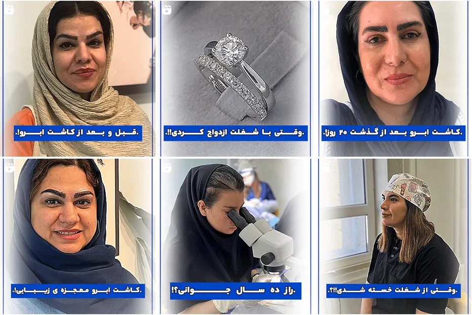 تصویر یکی از بهترین دکتر کاشت ابرو در مشهد را مشاهده میفرمایید