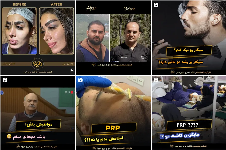 نمونه کار یکی از بهترین کلینیک کاشت ابرو در ساری را مشاهده میفرمایید.