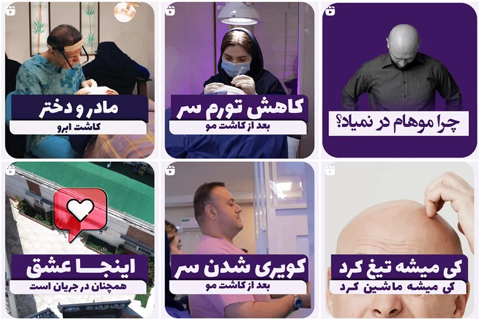 کاشت ابرو ساری در کلینیک پدیده کاملا قابل انجام و رزرو است