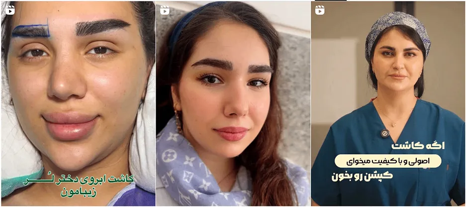 نمونه کار یکی از بهترین کلینیک کاشت ابرو در قزوین را مشاهده میفرمایید.