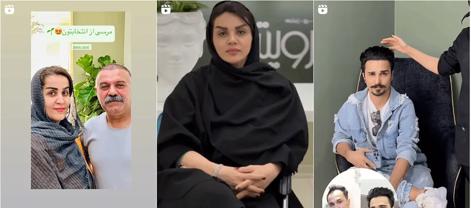 نمونه کار یکی از بهترین مرکز کاشت ابرو گرگان را مشاهده میفرماییید.