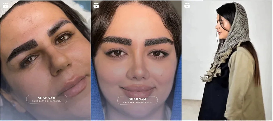 نمونه کار یکی از بهترین متخصصین کاشت ابرو همدان را مشاهده میفرمایید.