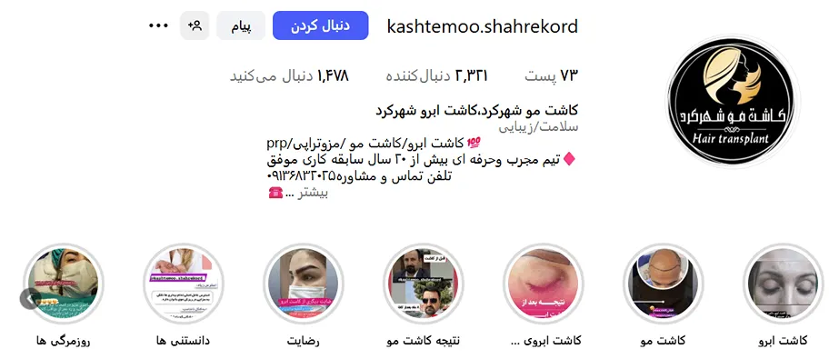 کاشت ابرو در شهرکرد در کلینکی تخصصی شهرکرد کاملا قابل انجام است