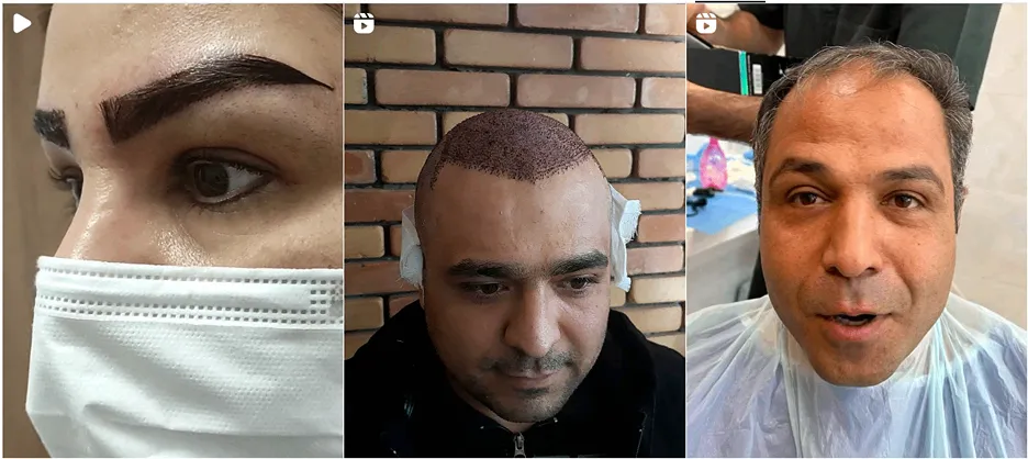 کاشت ابرو شهرکرد در کلینیک زیبایی تخصصی شهرکرد کاملا قابل انجام است