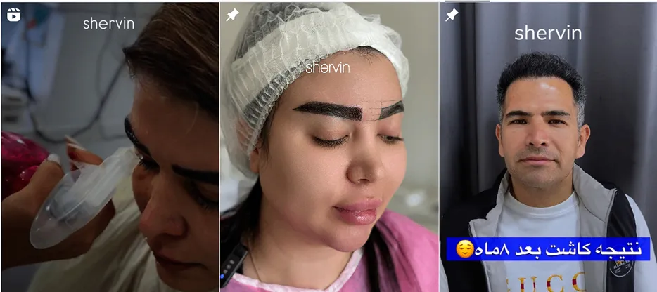 کاشت ابرو ارومیه در نزد خانم شروین میرزایی کاملا قابل انجام است