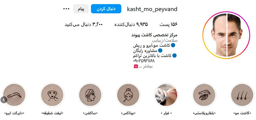 کاشت ابرو گرگان در کلینیک پیوند کاملا قابل انجام است