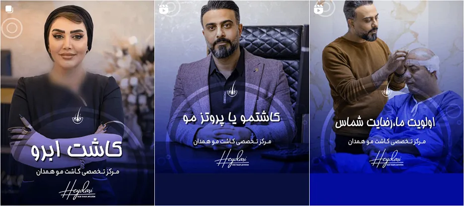 کاشت ابرو همدان در کلینیک زیبایی بوعلی کاملا قابل انجام است