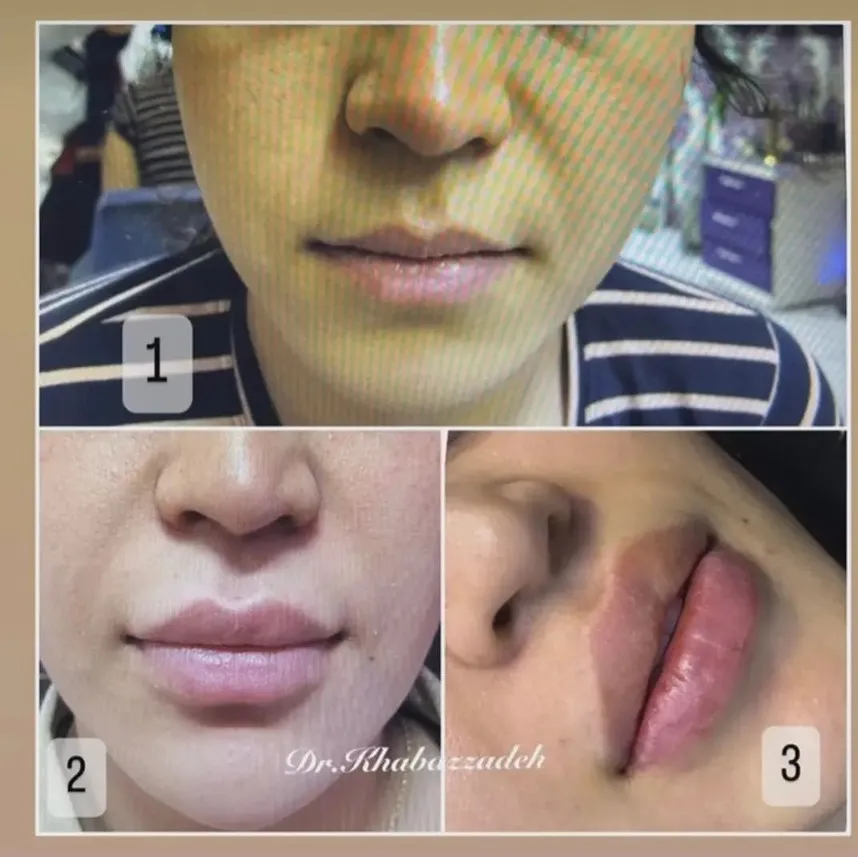 قیمت تزریق ژل در مشهد به شرایط گوناگون و متفاوتی وابسته است