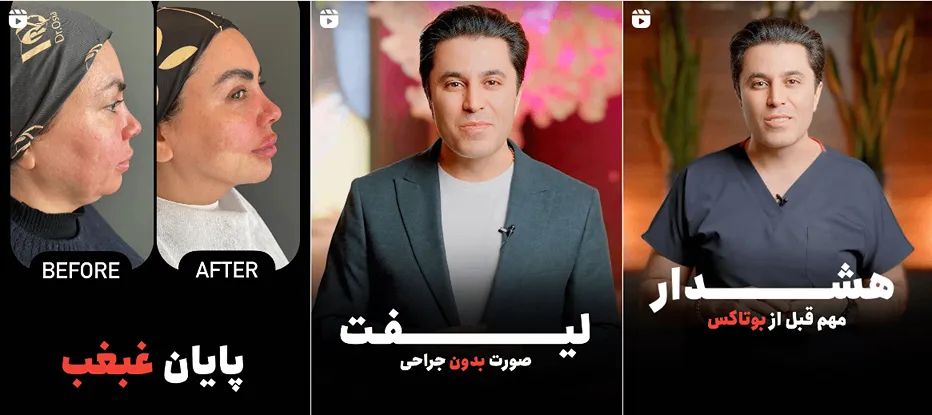 بوتاکس در یزد توسط دکتر حامی فرد کاملا قابل انجام است