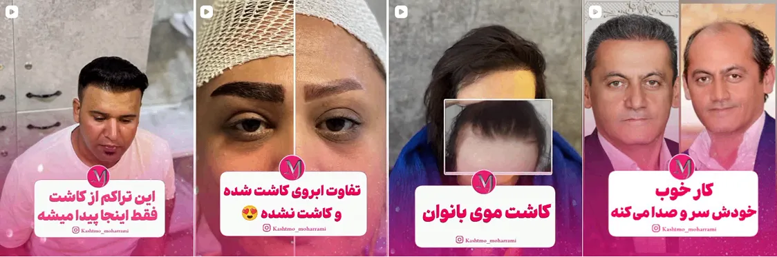 کاشت ابرو تبریز در کلینیک خانم محرمی کاملا قابل انجام است