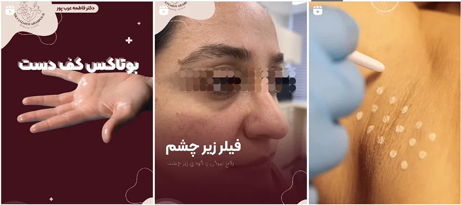 نمونه کار دکتر عرب پور از بهترین دکتر بوتاکس تبریز را مشاهده میفرمایید.