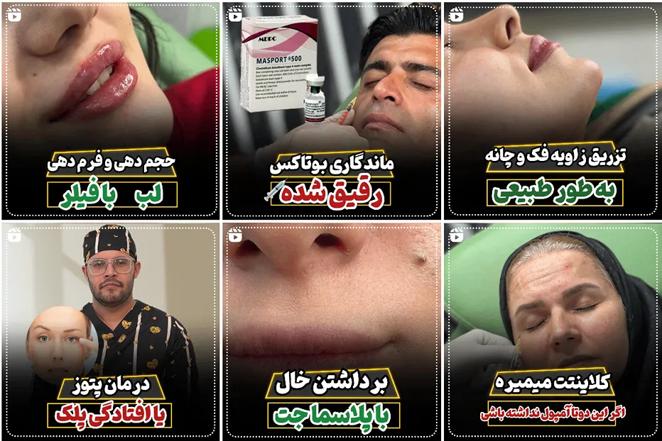 بوتاکس در ساری در کلینیک درمیس کاملا قابل انجام است