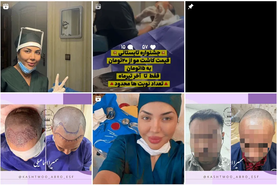 کاشت ابرو اصفهان در نزد سمیرا اسماعیلی کاملا قابل انجام است