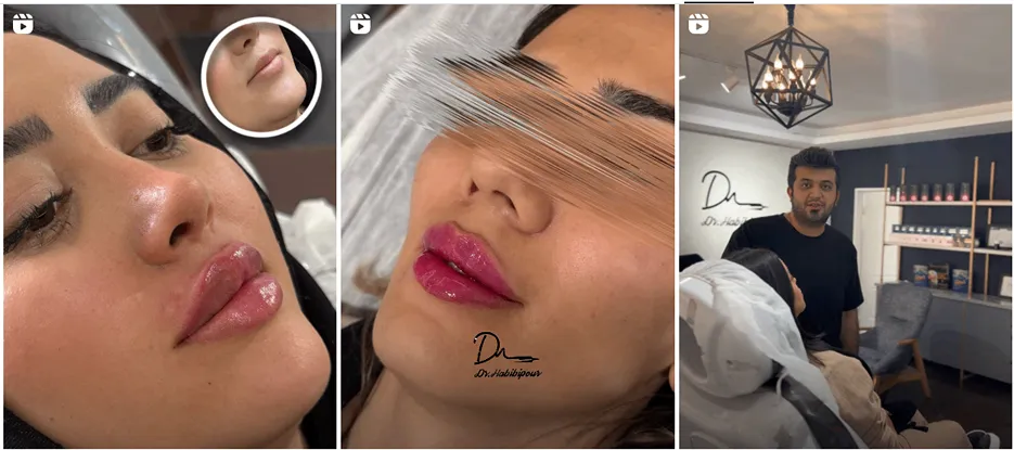 نمونه کار بوتاکس تریز دکتر حبیبی پور را مشاهده میفرمایید.