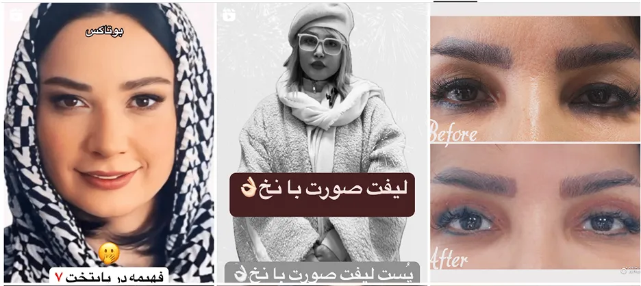 نمونه کار یکی از بهترین دکتر بوتاکس اردبیل را مشاهده میفرمایید.