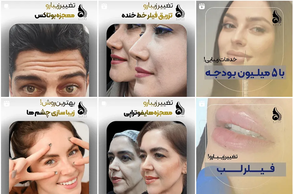 تزریق بوتاکس د ساری در کلینیک کاژه کاملا قابل انجام است