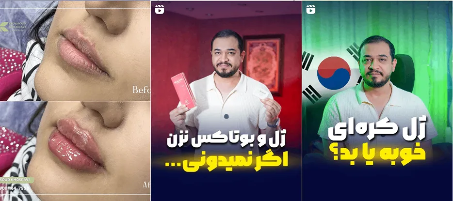 بوتاکس در شیراز توسط دکتر خسروی کاملا قابل انجام است