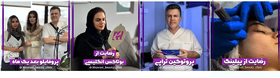 نمونه کار یکی از بهترین دکتر بوتاکس در ساری را مشاهده میفرمایید.