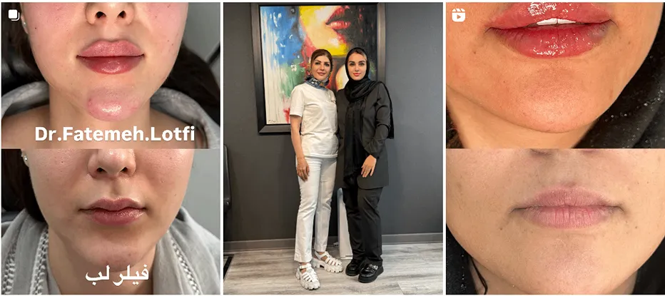 نمونه کار یکی از بهترین دکتر بوتاکس اراک را مشاهده میفرمایید.