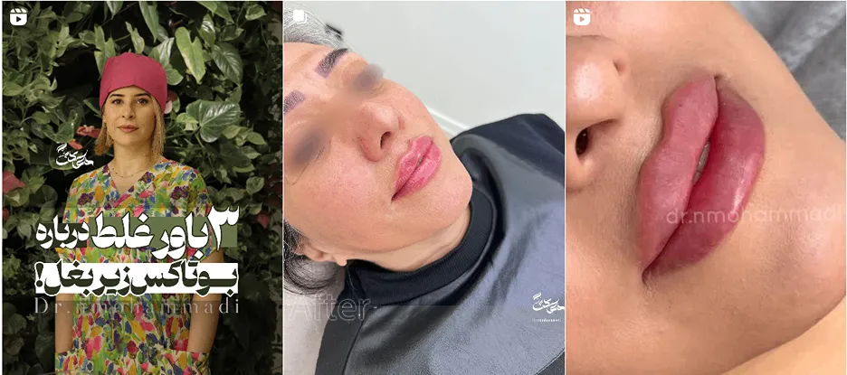نمونه کار یکی از بهترین دکتر بوتاکس گرگان را مشاهده میفرمایید.