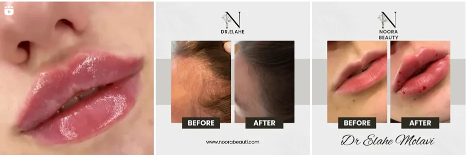 هزینه تزریق ژل در مشهد به عوامل مختلفی وابسته است