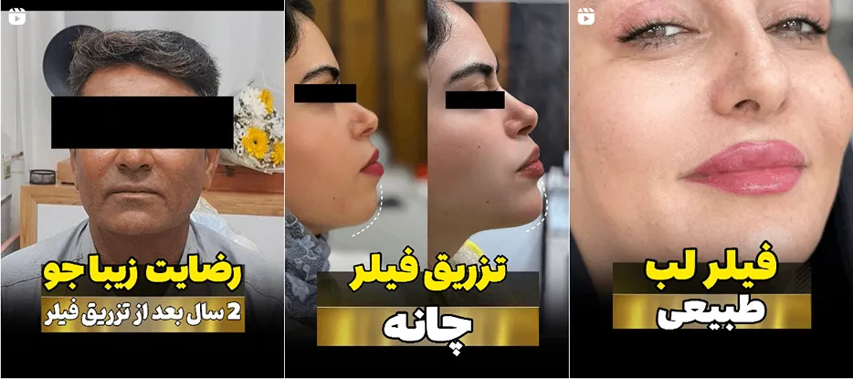 نمونه کار یکی از باتجربه ترنی دکتر بوتاکس بندربعاس را مشاهده میفرمایید.