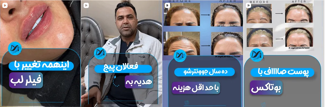 نمونه کار دکتر بوتاکس همدان را در این تصویر مشاهده میفرمایید.