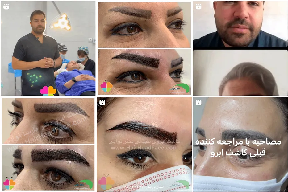 کاشت ابرو در اصفهان توسط دکتر نوایی کاملا قابل انجام است