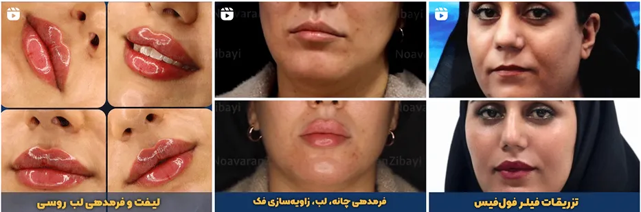 نمونه کار بهترین کلینیک تزریق ژل در مشهد را مشاهده میفرمایید.