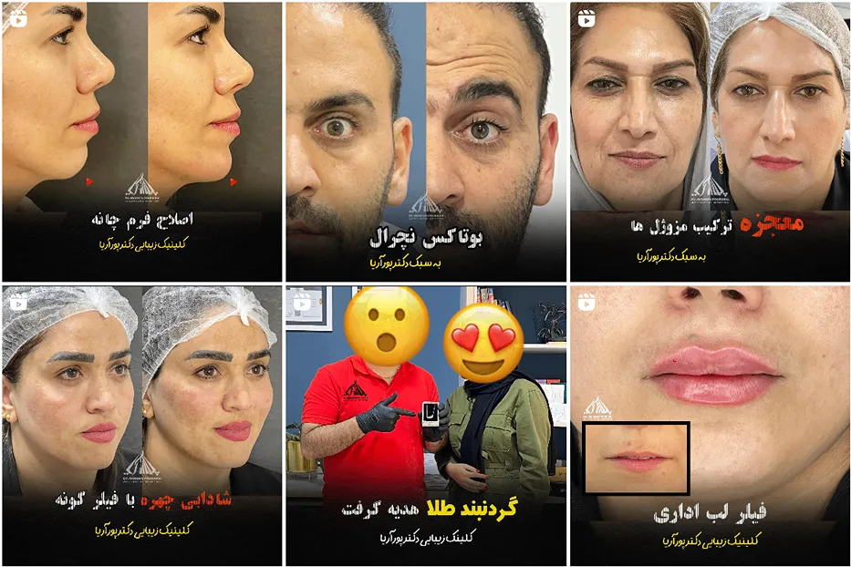 بوتاکس ساری توسط دکتر پورآریا کاملا قابل انجام است