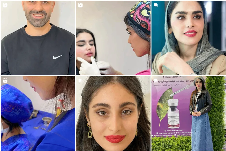 دکتر رنجبر از بهترین دکتر بوتاکس در ساری است