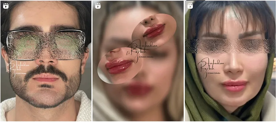 نمونه کار بهترین دکتر بوتاکس در همدان را مشاهده میفرمایید.