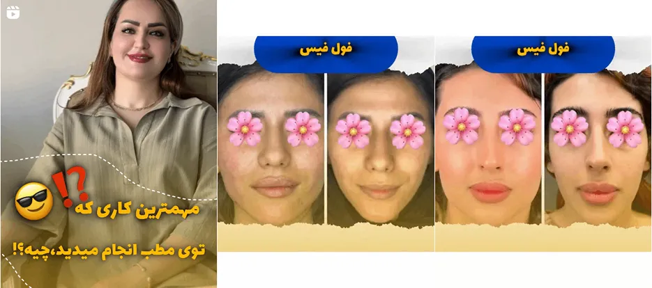 نمونه کار یکی از بهترین دکتر بوتاکس یزد را مشاهده میفرمایید.