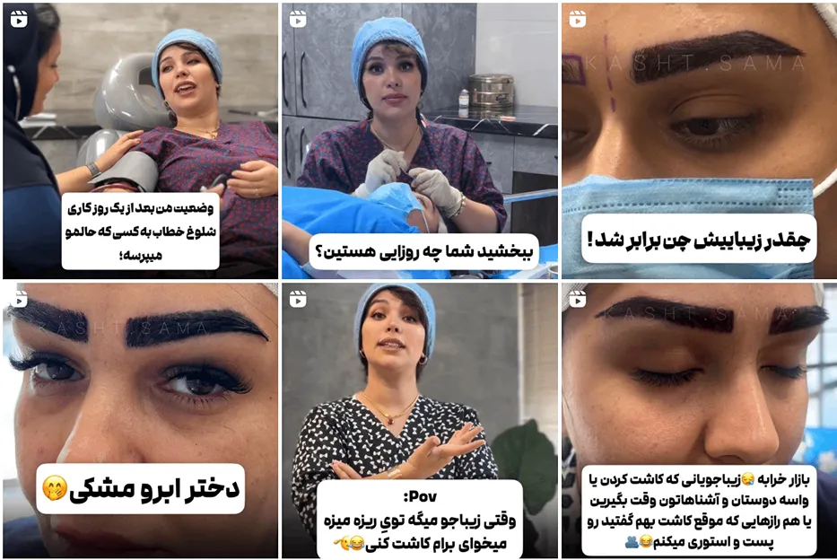 کاشت ابرو تبریز در کلینیک سما کاملا قابل انجام است