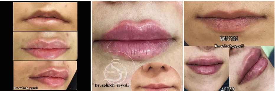 دکتر صادقی از بهرتین دکتر تزریق ژل در مشهد است