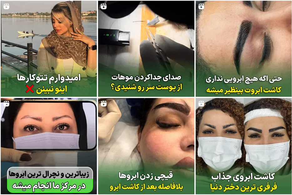 نمونه کار یکی از بهترین دکتر کاشت ابرو اهواز را مشاهده میفرمایید.