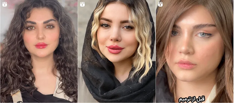 نمونه کار یکی از بهترین دکتر بوتاکس در اردبیل را مشاهده میفرمایید.