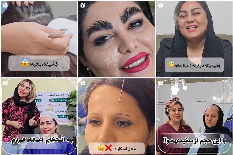 کاشت ابرو اهواز توسط خانم شیرازدگان کاملا قابل رزرو است