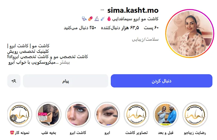 کاشت ابرو تبریز توسط خانم سیما کاملا قابل انجام است