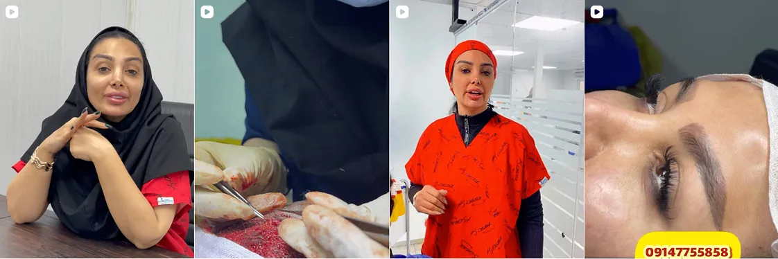 کاشت ابرو تبریز توسط خانم سیما فدایی کاملا قابل انجام است