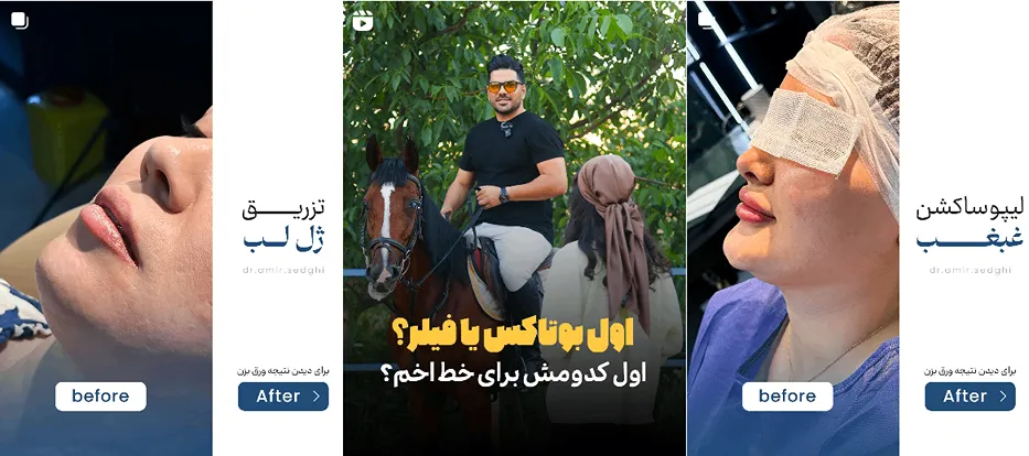 نمونه کار بهترین دکتر بوتاکس ارومیه را مشاهده میفرمایید.