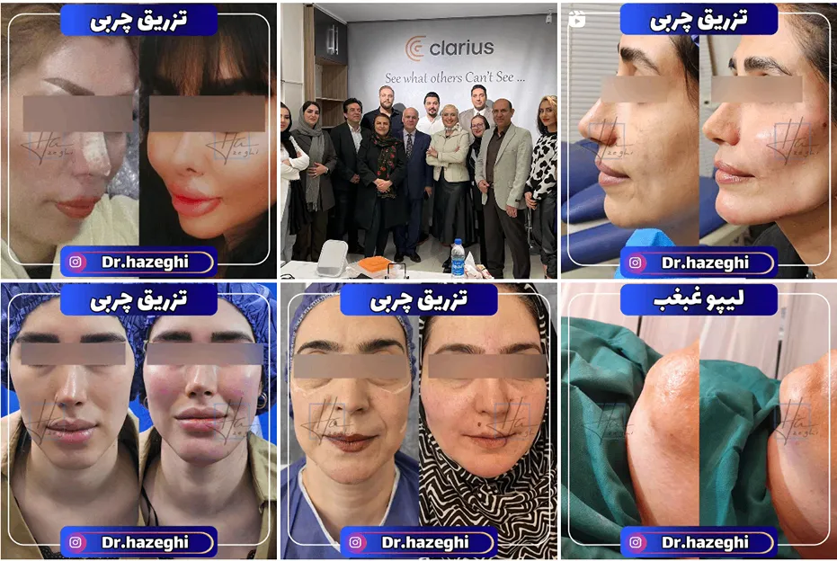 تزریق چربی در مشهد توسط دکتر خاذقی کاملا قابل انجام است