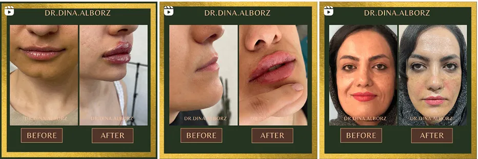 اندولیفت در مشهد توسط دکتر البرز قابل انجام است