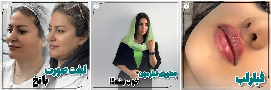 کلینیک زیبایی الین یکی از بهترین کلینیک لیفت صورت در مشهد است