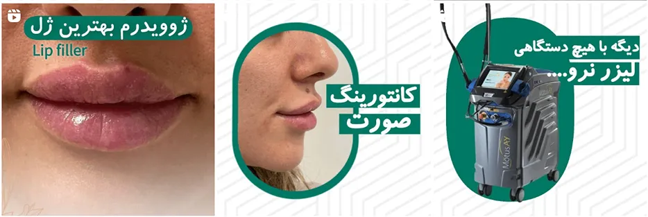 یبفاروپلاستی در مشهد در کلینیک زیبایی التیام کاملا قابل انجام است