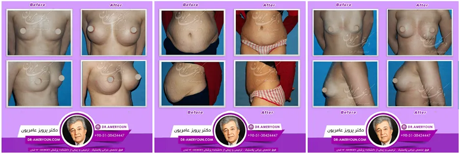 پروتز سینه در مشهد توسط دکتر عامریون کاملا قابل انجام است